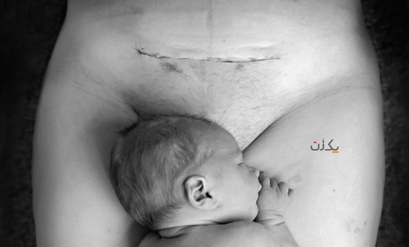عوارض بعد از زایمان سزارین